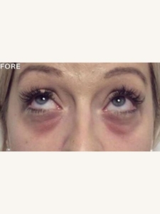 Tear Trough Fillers for Under-Eye Discolouration Before