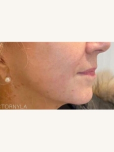 Ultracel Q+ Treatment After