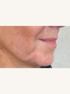 Ultracel Q+ Treatment Before