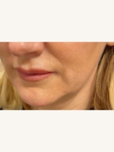 Ultracel Q+ on Facial Skin Before