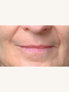 Ultracel on Lip Wrinkles After