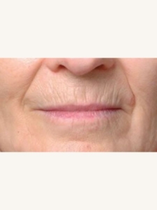 Ultracel on Lip Wrinkles Before