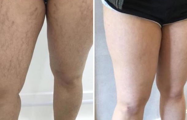 Stretch Marks On Thighs Before & After