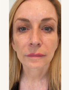 skin tightening face after