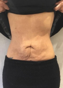 skin tightening stomach after