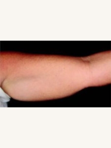 Arm Fat Removal Before