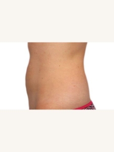 Belly Fat Removal After