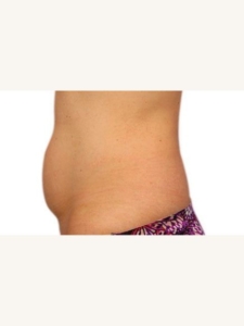 Belly Fat Removal Before