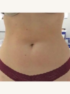 Fat Reduction Treatment After