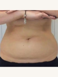 Fat Reduction Treatment Before