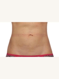 Stomach Fat Removal After