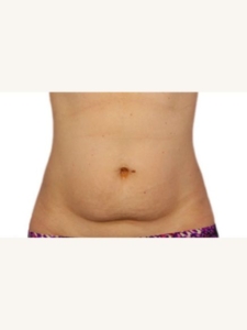 Stomach Fat Removal Before