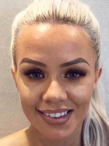 Botox Treatment After