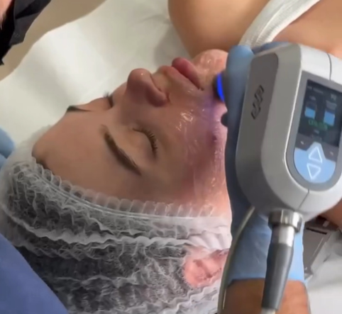 Exilis Treatment London