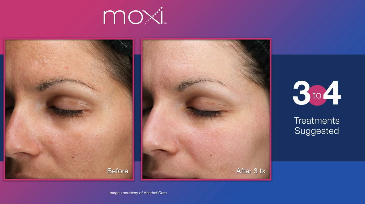 MOXI Laser Skin Treatment Explainer Video Thumbnail
