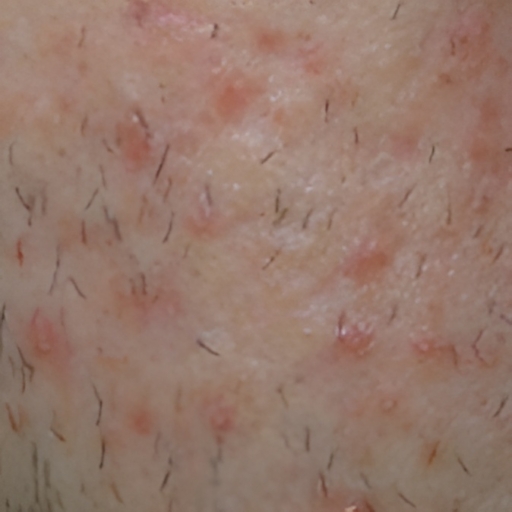 Body-Acne-Treatment-Before