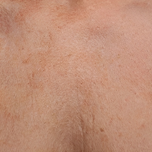 Chest Ultherapy After