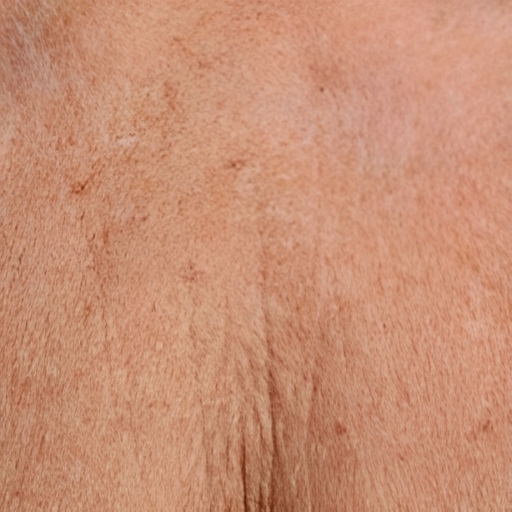 Chest Ultherapy Before