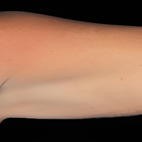 CoolSculpting on Arms After
