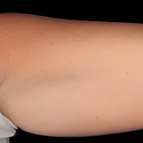 CoolSculpting on Arms Before