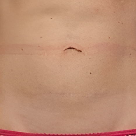 CoolSculpting on Belly After
