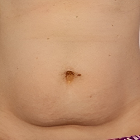 CoolSculpting on Belly Before