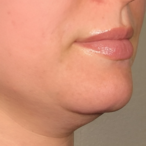 Lower Face Ultherapy Before