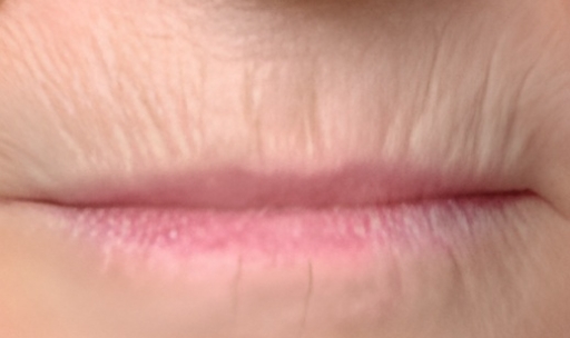 Ultracel on Lip Wrinkles Before