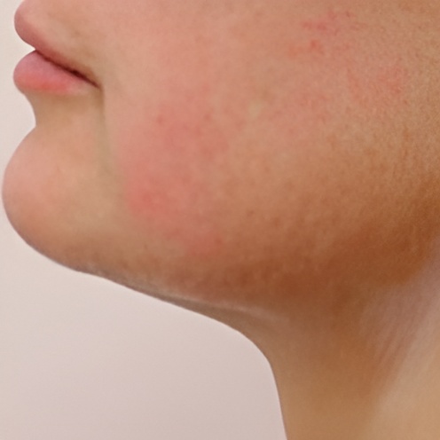 Ultraformer-3-Chin-Tightening-After