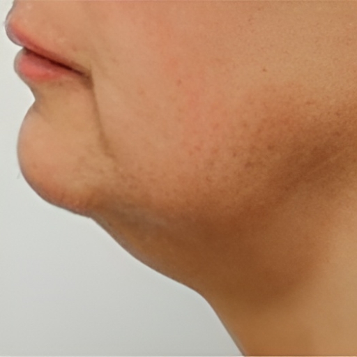 Ultraformer-3-Chin-Tightening-Before