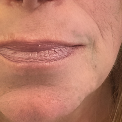 Ultraformer 3 Jowl Skin Tightening After