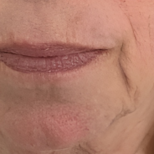 Ultraformer 3 Jowl Skin Tightening Before
