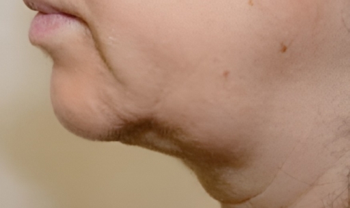 Ultraformer 3 Jowls Skin Tightening Before