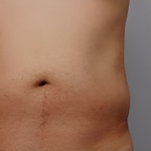 Ultraformer-3-Mens-Stomach-Skin-Tightening-After