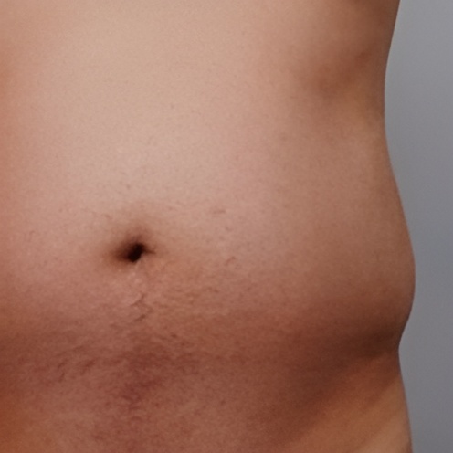 Ultraformer 3 Mens Stomach-Skin-Tightening-Before