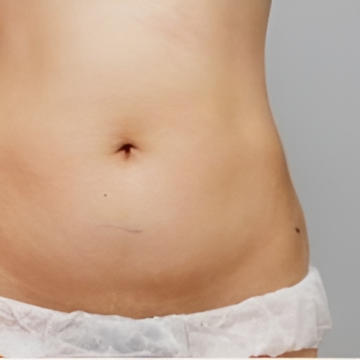Ultraformer 3 Stomach Skin Tightening After