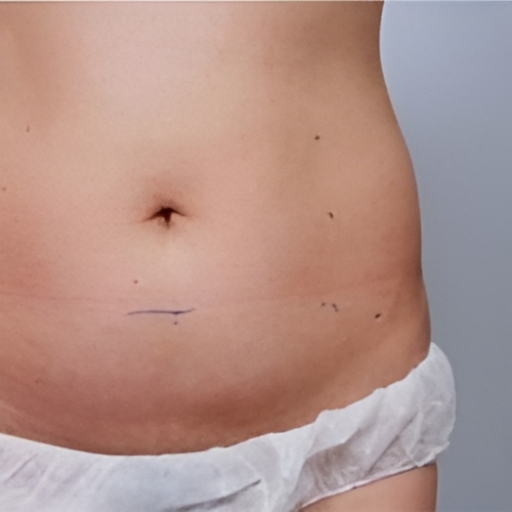Ultraformer 3 Stomach Skin Tightening Before
