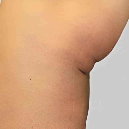 Unison Cellulite Treatment After 1
