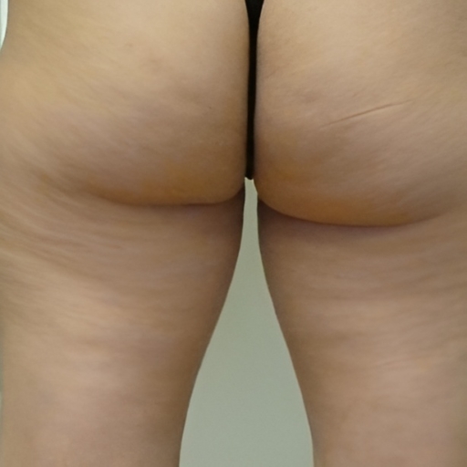 Unison Cellulite Treatment Before 3