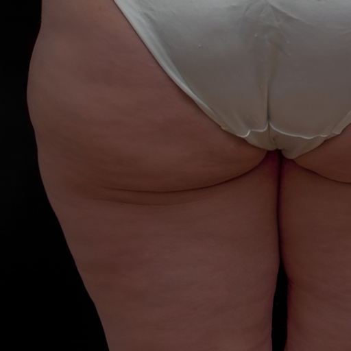Unison Cellulite a4