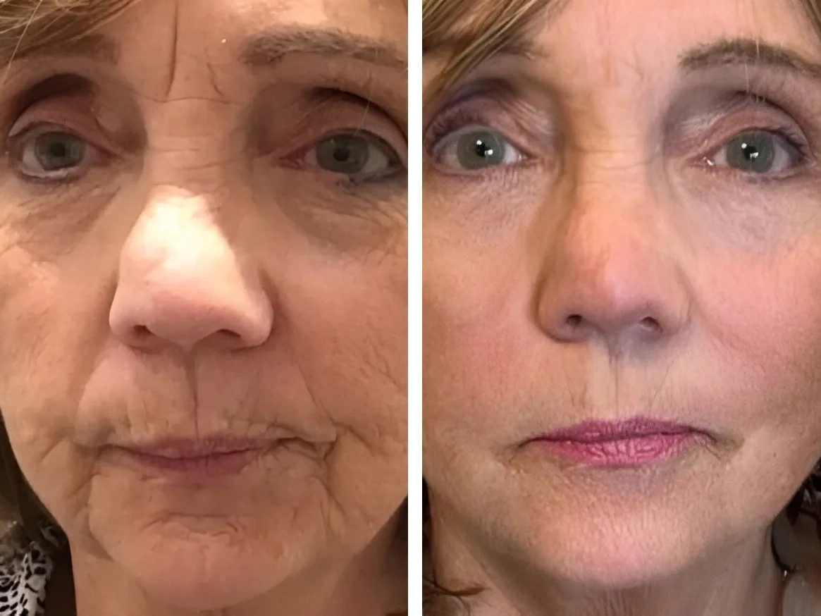 Exilis Elite for skin tightening before and after results at Dr Nyla Medispa in Mayfair, London