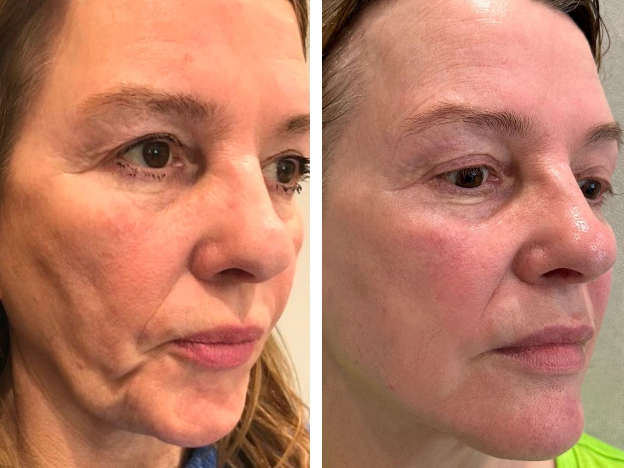 Before and after Ultherapy treatment for the face at Dr Nyla Medispa in Mayfair, London
