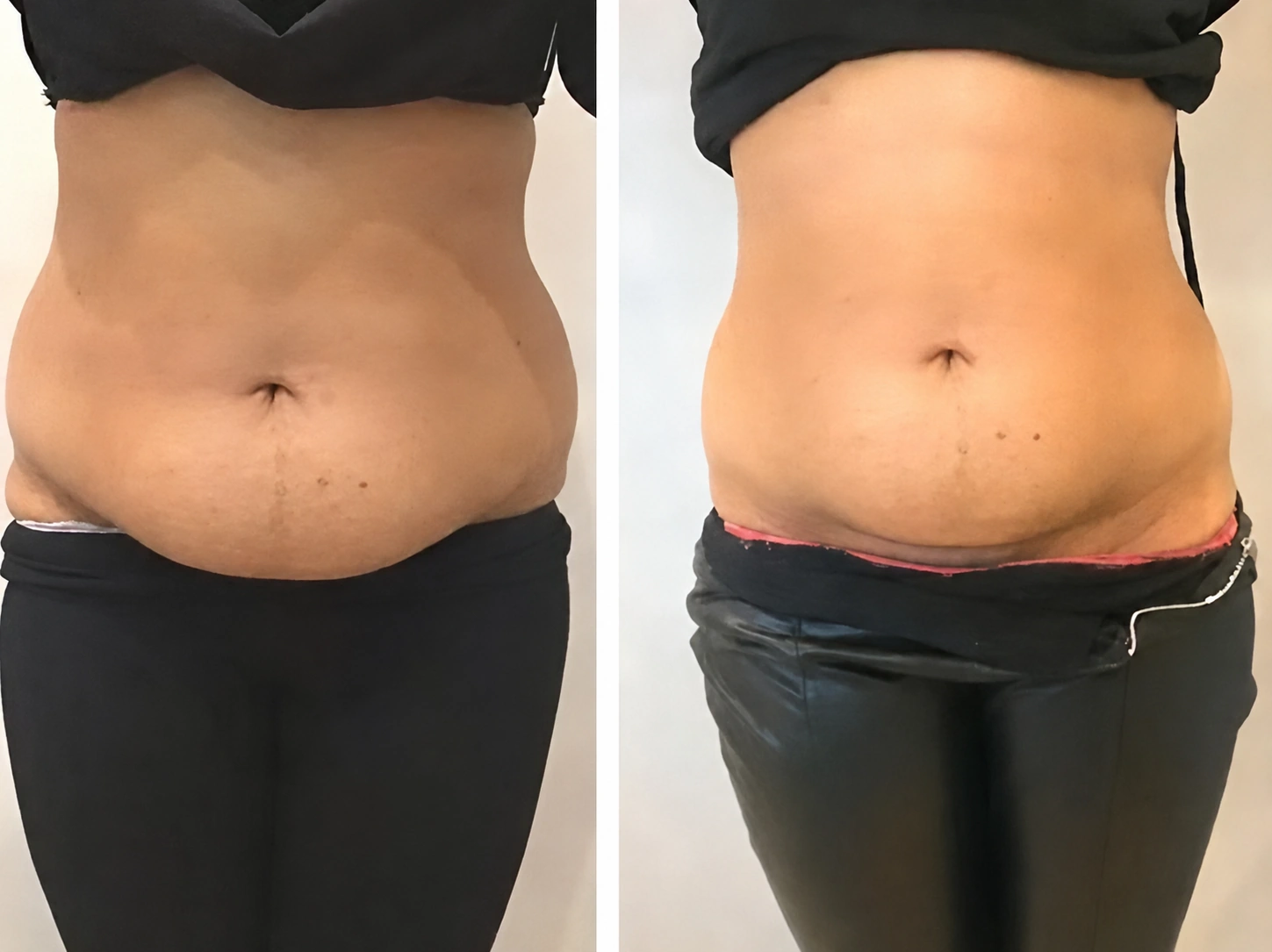 CoolSculpting before and after on a patient's stomach at Dr Nyla Medispa in Mayfair, London