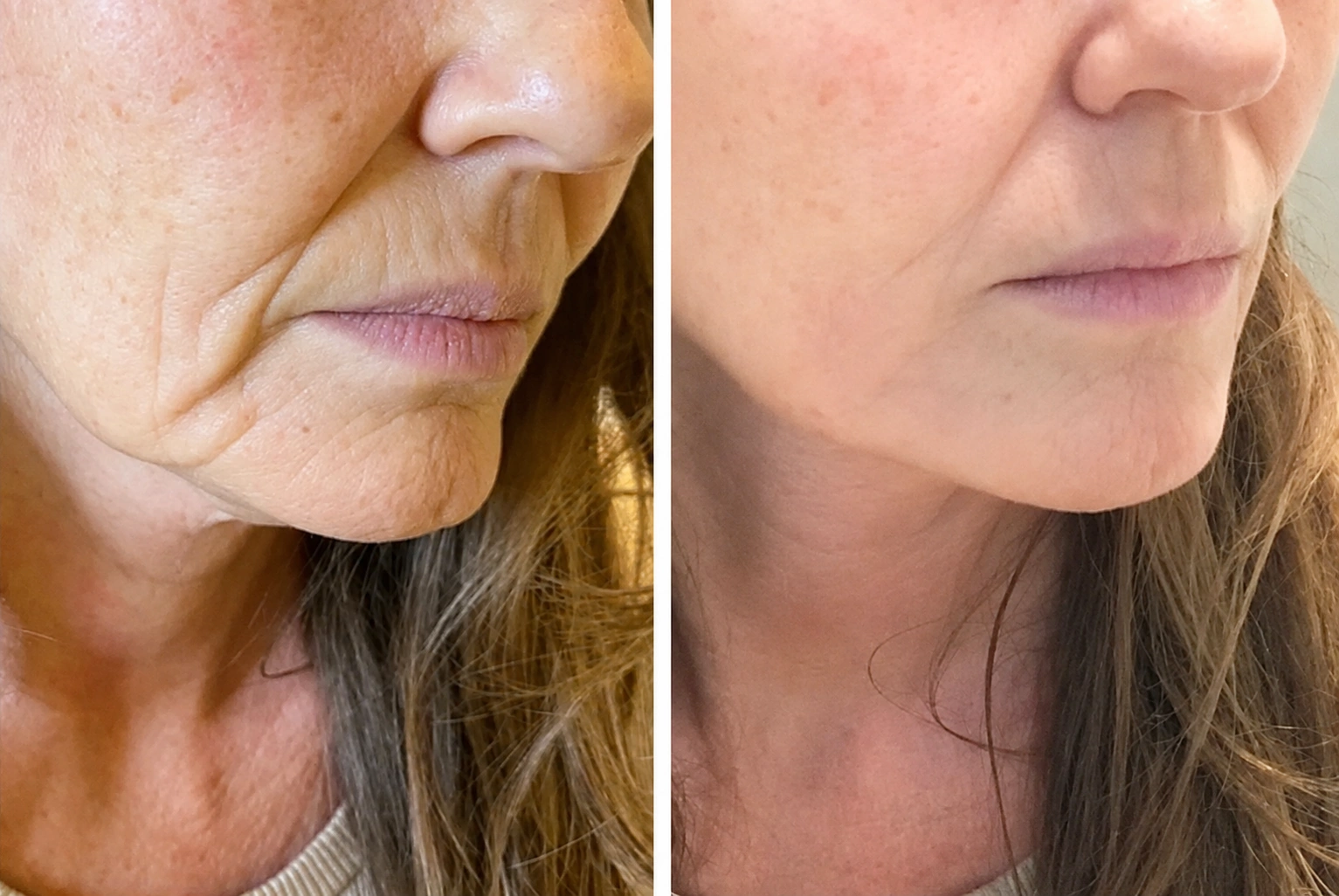 Before and after Morpheus8 RF Microneedling treatment for the face at Dr Nyla Medispa in Mayfair, London