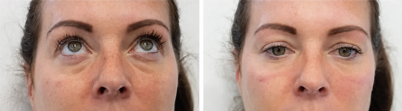 Before and after tear trough filler results at Dr Nyla Medispa in Mayfair, London