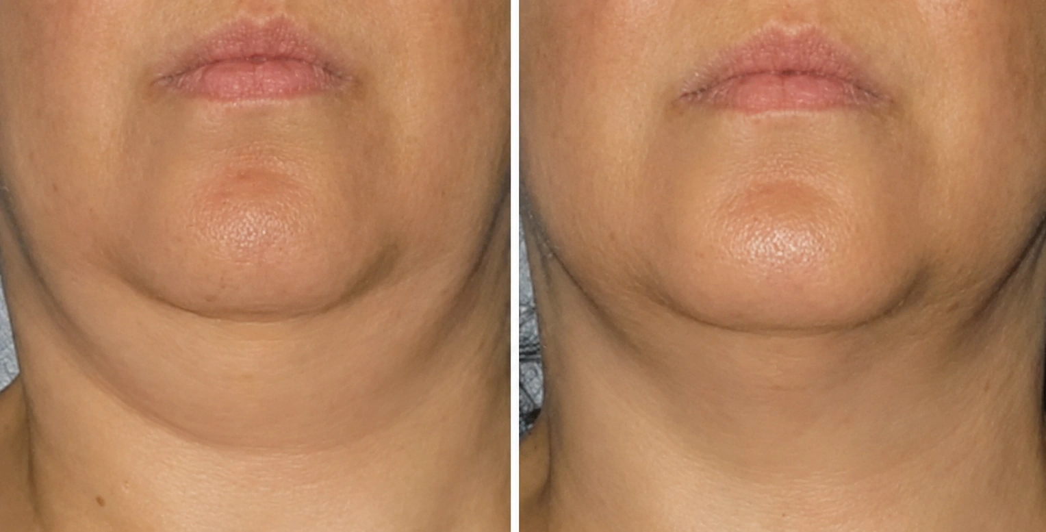 CoolSculpting before and after on a patient's double chin at Dr Nyla Medispa in Mayfair, London
