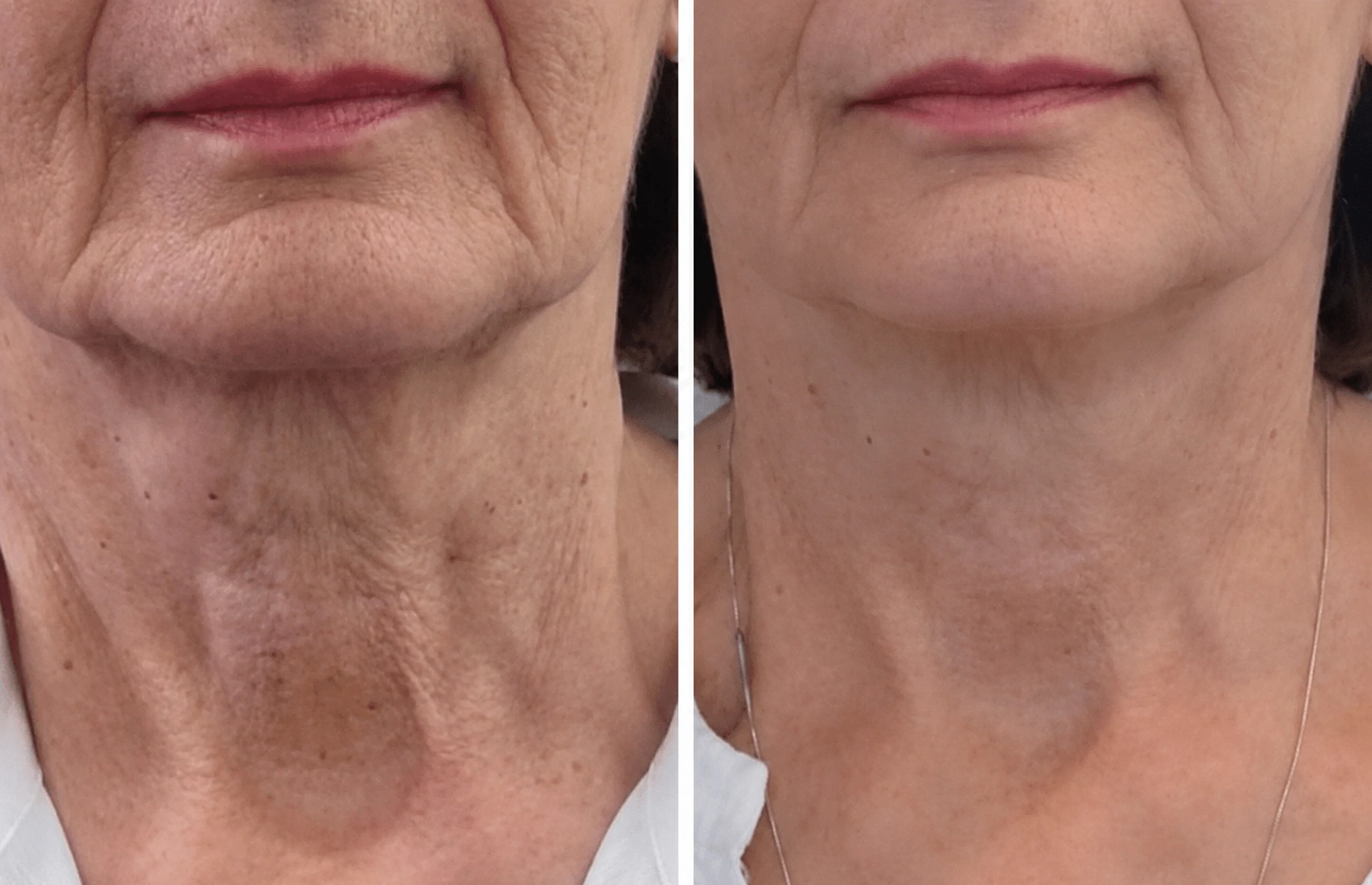 Before and after Profhilo treatment for the neck at Dr Nyla Medispa in Mayfair, London