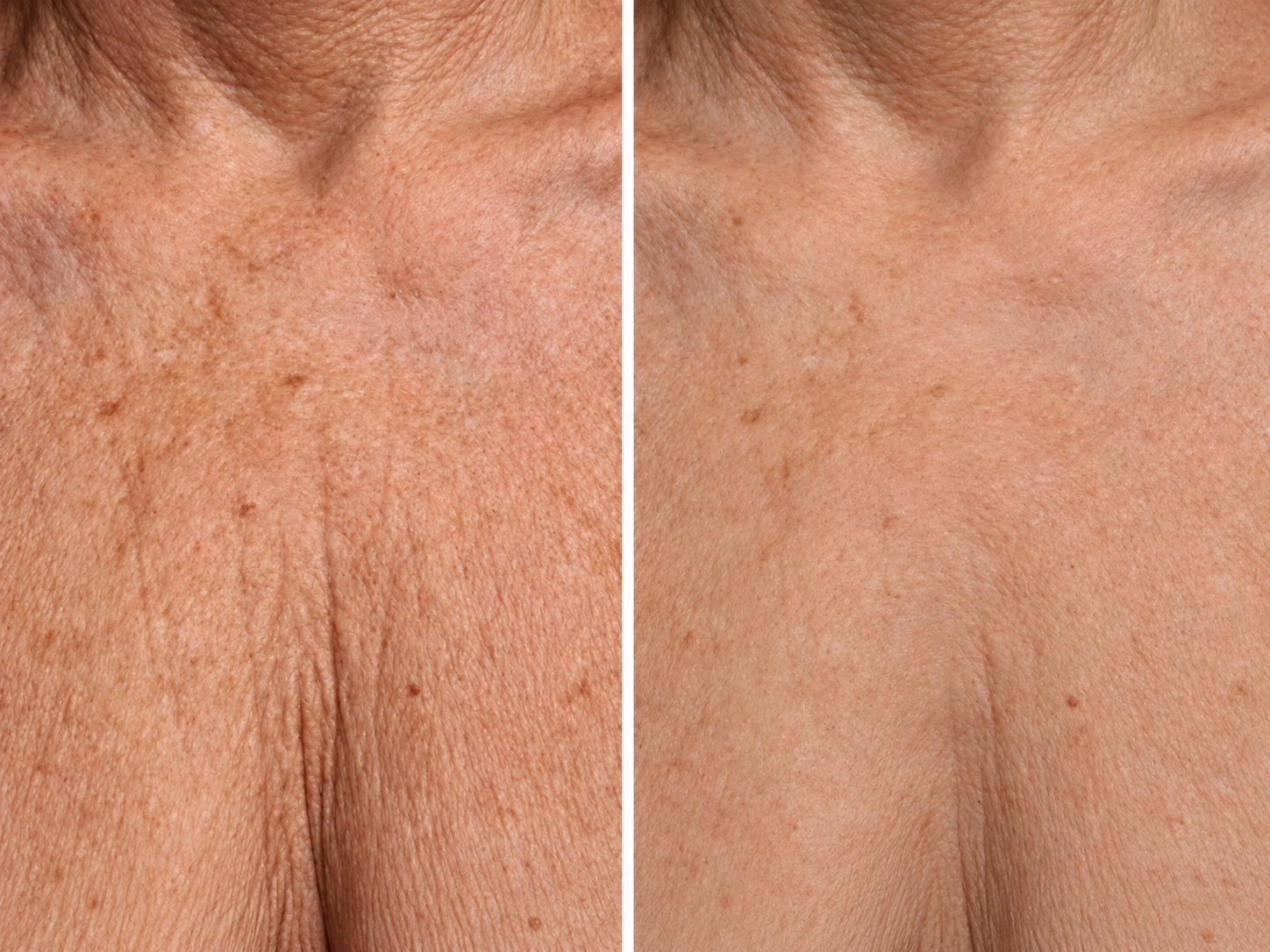 Before and after Ultherapy treatment for the chest area at Dr Nyla Medispa in Mayfair, London