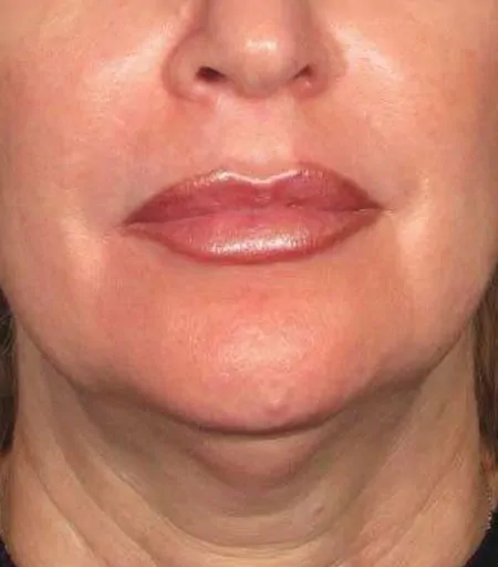 ultherapy before 2