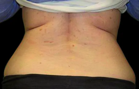 exilis-ba-back-after4tx
